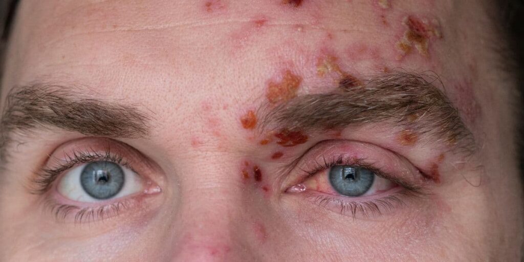 Meth Mites - Alt Text